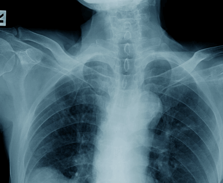 radiografía_respiratorios_Chiesi